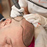 Man Achieves Boost in Self-Confidence Following Hair Transplant Abroad